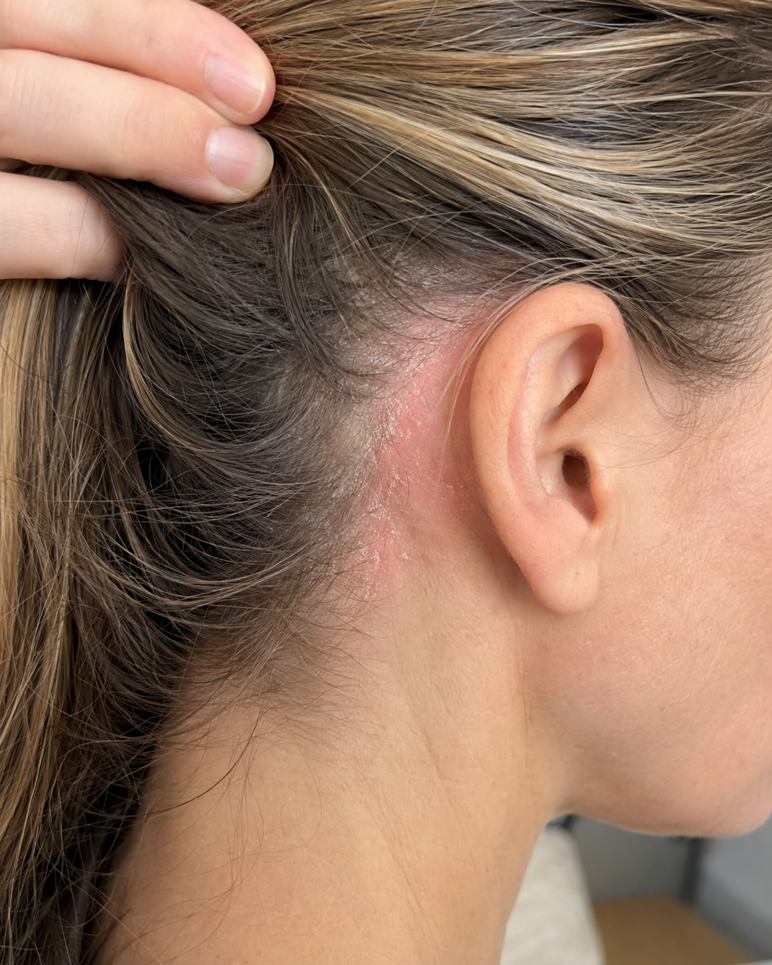 Close-up of irritated flaky scalp near the hairline